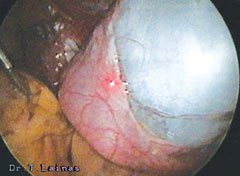 Para-ovarian cyst during removal with laser laparoscopic surgery.